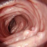 Colon polyps