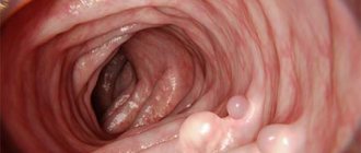 Colon polyps