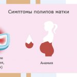 Signs of polyp formation