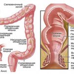 Proctitis (inflammation of the rectum)