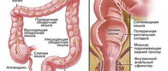 Проктит (воспаление прямой кишки)