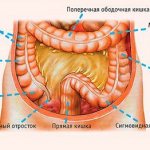 Рак ободочной кишки