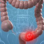 Рак толстой кишки: первые симптомы и лечение
