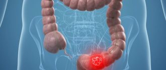 Colon cancer: first symptoms and treatment