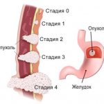 stomach cancer stage