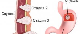 stomach cancer stage