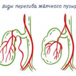 Types of gallbladder kinks