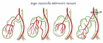 Разновидности перегибов жёлчного пузыря