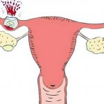 Разрыв маточной трубы при внематочной беременности