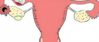 Разрыв маточной трубы при внематочной беременности
