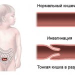 Development of intestinal obstruction in children