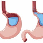 Reflux esophagitis