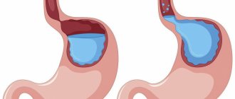 Reflux esophagitis