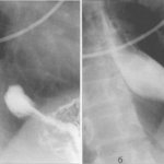 Radiographs of the esophagus at the level of the diaphragmatic opening.