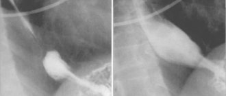 Radiographs of the esophagus at the level of the diaphragmatic opening.