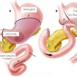 resection using Billroth method 2