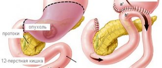 resection using Billroth method 2