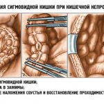 Resection of a section of intestine