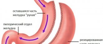 Gastric resection