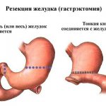 Резекция желудка