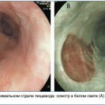 Rice. 7. Heterotopia of the coolant in the proximal esophagus: examination in white light (A) and improved visualization when examined in a narrow spectrum (B) 