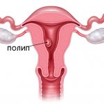 drawing of a uterus with a polyp