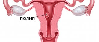 drawing of a uterus with a polyp