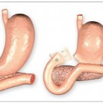 Scar stenosis