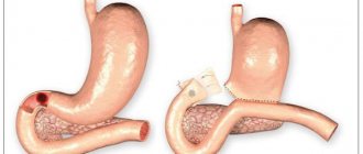 Scar stenosis