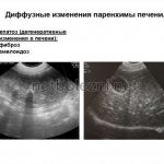 Serious pathologies with diffuse changes