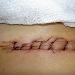 suture after appendicitis