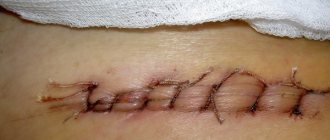 suture after appendicitis