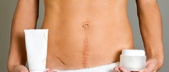 appendicitis scar