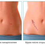 Sutures after laparoscopy and traditional surgery