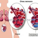 Accumulation of fluid in the alveoli