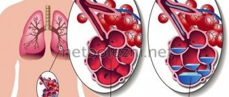 Accumulation of fluid in the alveoli