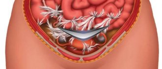 Спаечная болезнь кишечника
