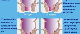 Stages of hemorrhoids