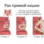 Stages of rectal cancer