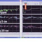 Daily pH-gram of a patient with GERD before (A) and against the background (B) of a single dose of 20 mg omeprazole accelerated release