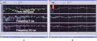 Daily pH-gram of a patient with GERD before (A) and against the background (B) of a single dose of 20 mg omeprazole accelerated release