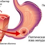 Терапевтические методы направлены на лечение пептической язвы, купирование воспаления, снятие симптомов, устранение раздражающих факторов.