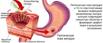 Therapeutic methods are aimed at treating peptic ulcers, relieving inflammation, relieving symptoms, and eliminating irritants.