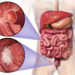 Types of intestinal tumors