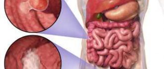 Types of intestinal tumors