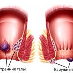 тромбоз наружного геморроидального узла