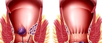 thrombosis of the external hemorrhoid