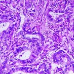 tubular adenocarcinoma of the stomach