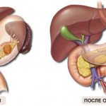 Removal of the tail of the pancreas and spleen