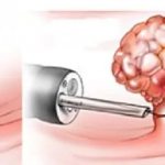 Removal of polyps in the intestines